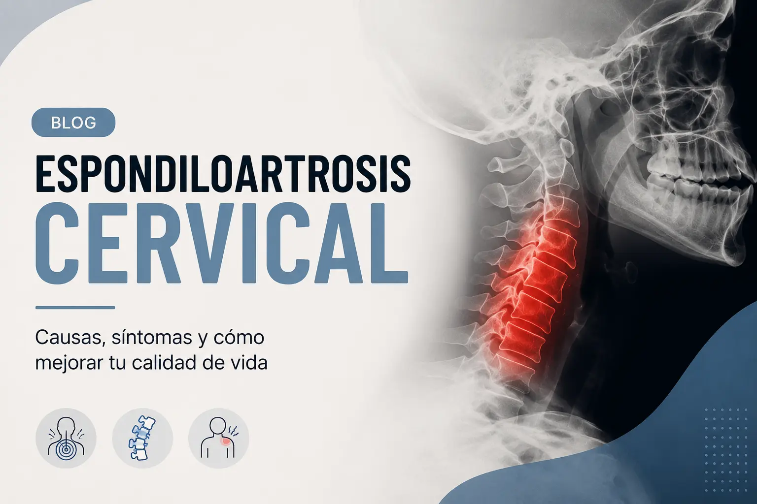 Espondiloartrosis Cervical- síntomas, causas y tratamiento Espondiloartrosis Cervical- síntomas, causas y tratamiento
